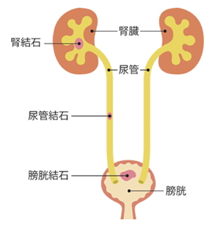 尿路結石症