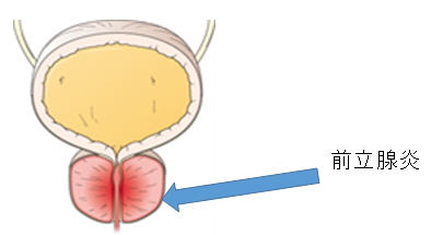前立腺炎