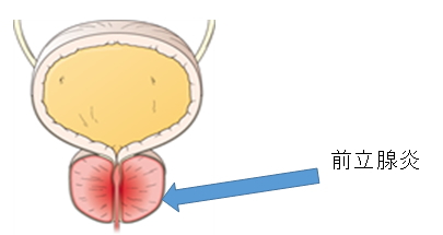 慢性細菌性前立腺炎の見通し