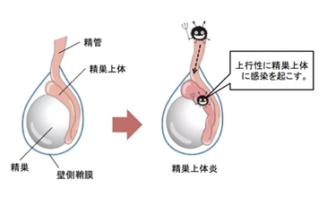 精巣上体炎（副睾丸炎）