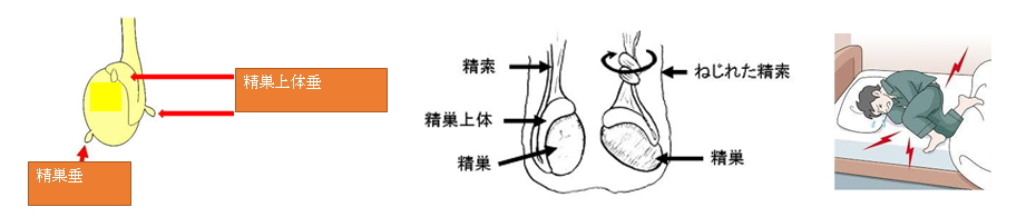 精巣捻転