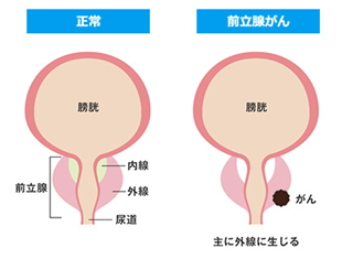 前立腺がん