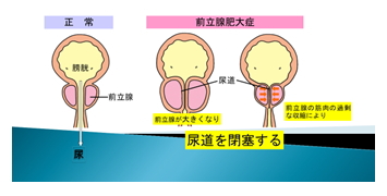 前立腺肥大症