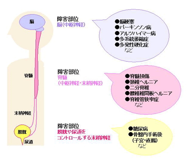 神経因性膀胱